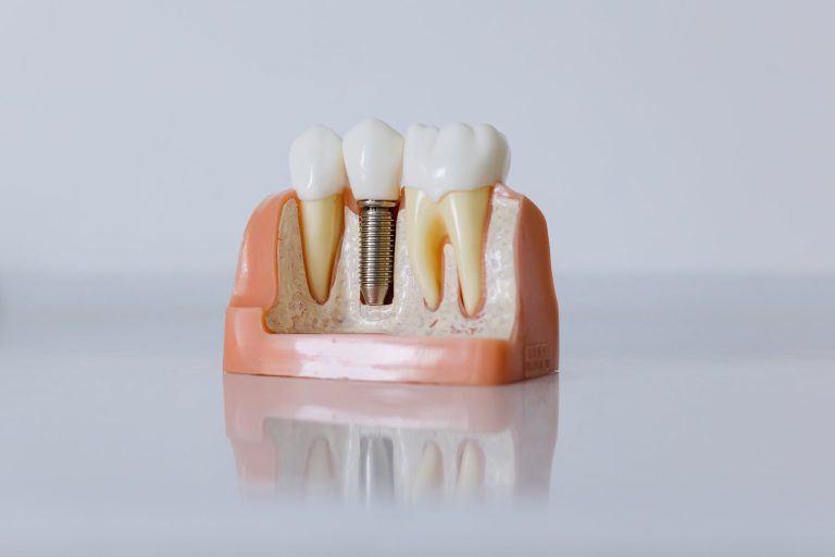 Close-Up Shot of Dental Implant Model